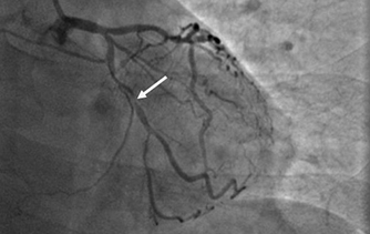 燕達(dá)研究院：成功開(kāi)展CD19 CAR-T細(xì)胞治療白血病臨床研究